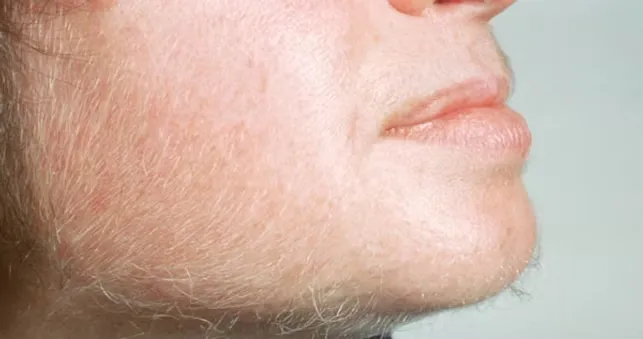 Excessive Hair Growth 6