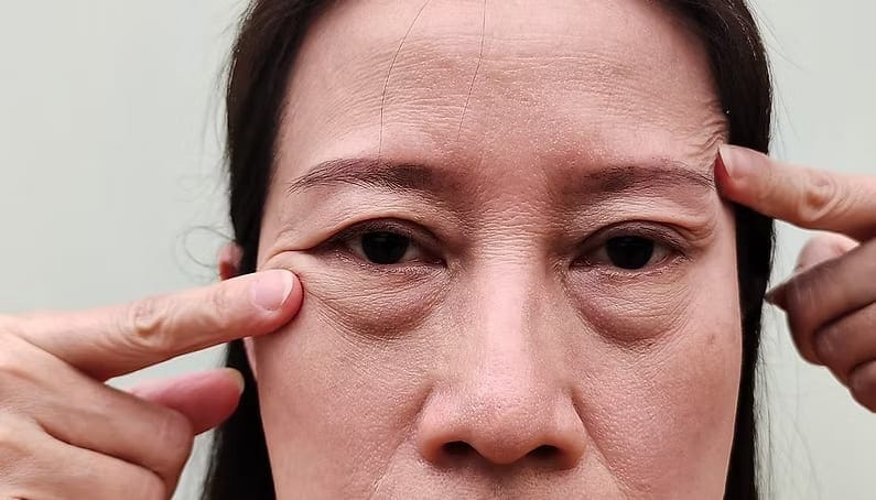 Eyebrow Sagging 2