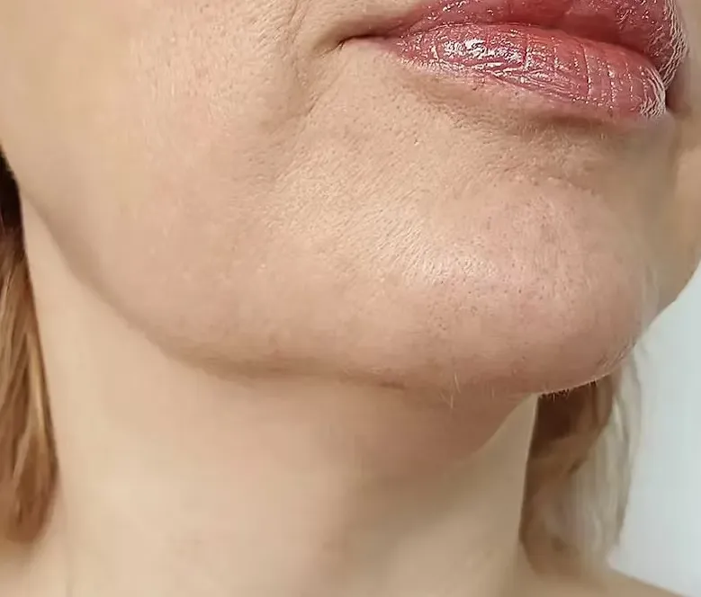 Jowls Sagging face 3