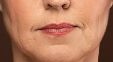 Jowls Sagging face 5