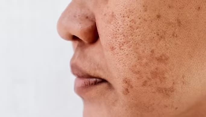Melasma 4