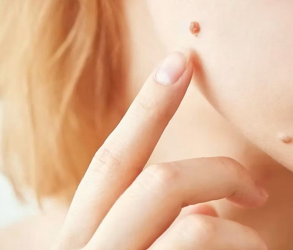 Moles and Their Removal 2 (1)