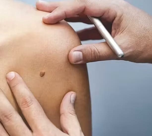 Moles and Their Removal 3