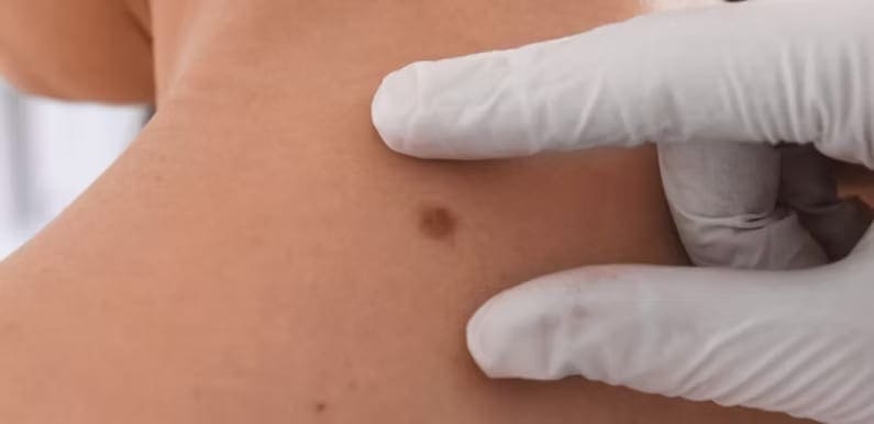 Moles and Their Removal 4