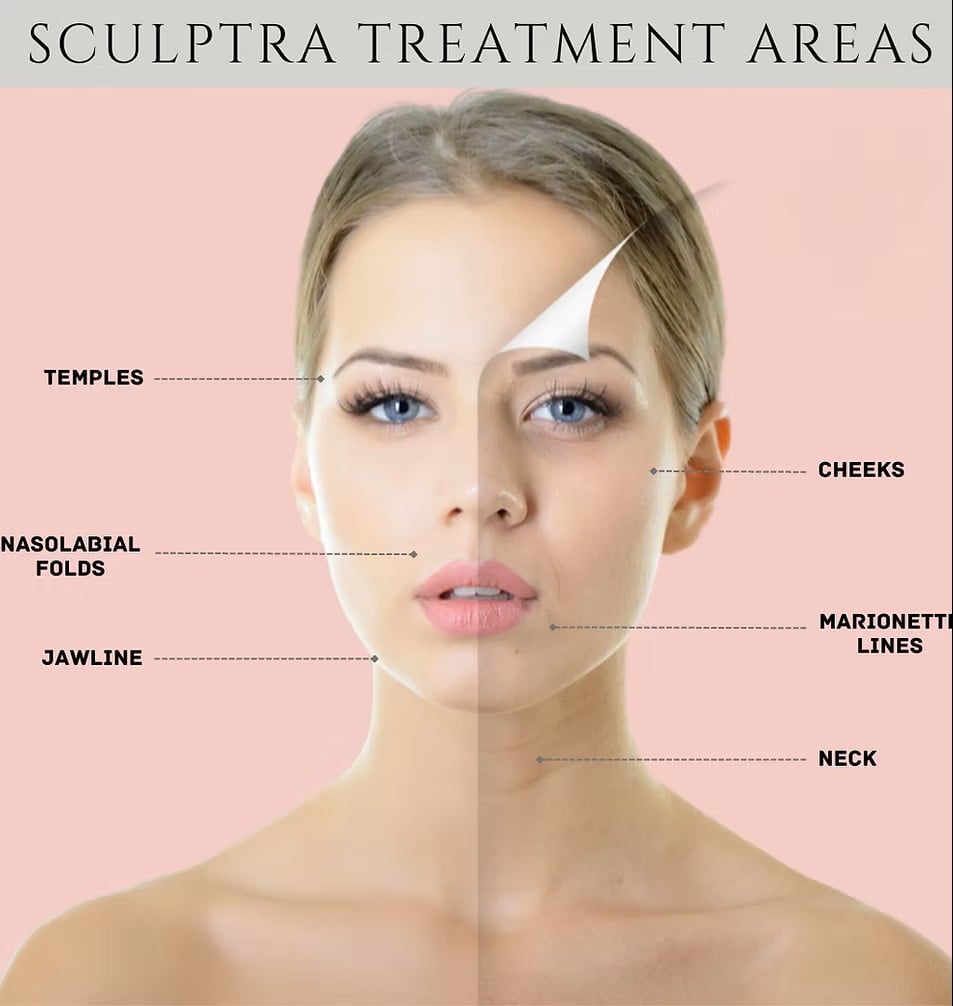 Sculptra Filler for Face