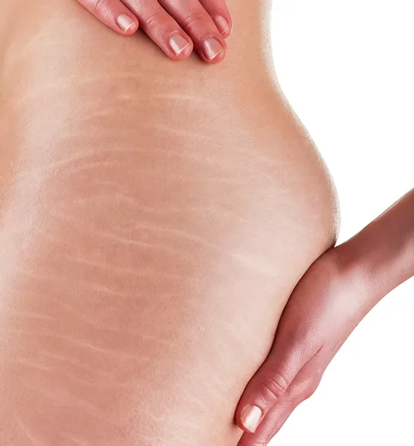 Stretch Marks 3