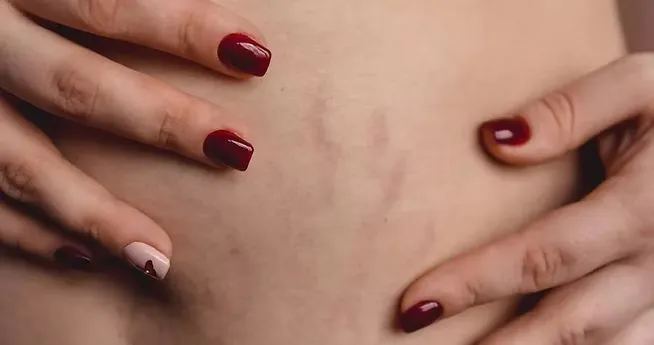 Stretch Marks 4