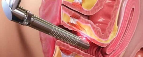laser-vaginal-tighteninglvt-dr-deepa-ganesh-laser-cosmetic-gynecology-clinic-510x362-1