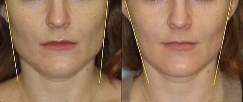 masseter-muscle-marked-up_edited