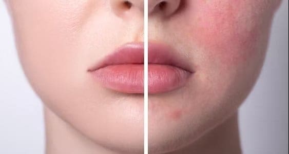 rosacea_treatment_before_after_600