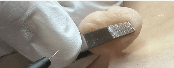 skin tag