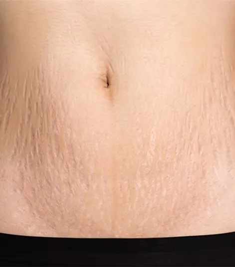 stretch-marks-7